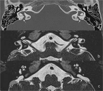 Clinical Implication of Caloric and Video Head Impulse Tests for Patients With Enlarged Vestibular Aqueduct Presenting With Vertigo